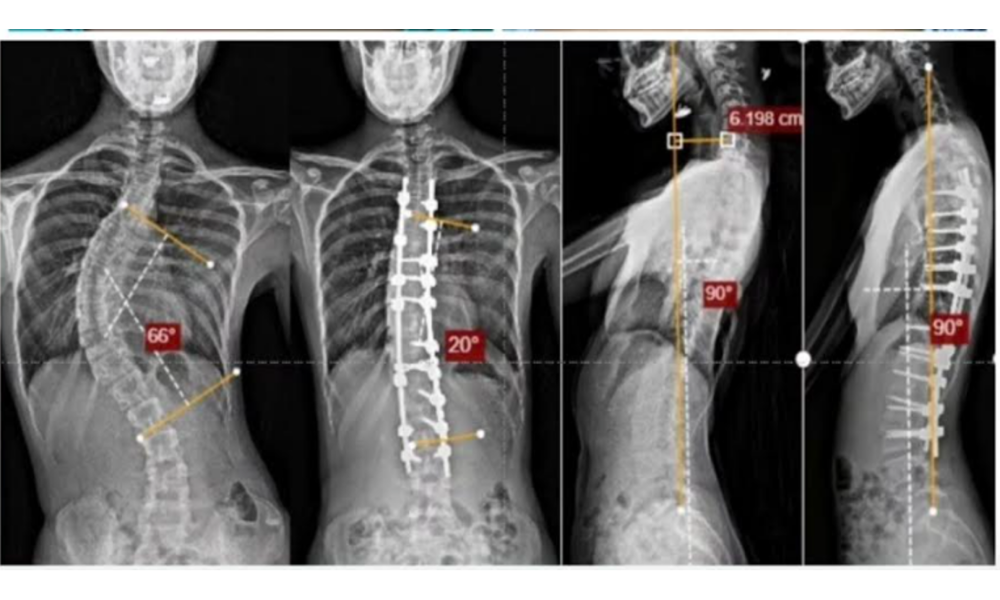 Precision Scoliosis Surgery | O-arm™ O2 Imaging System & S8 Navigation System
