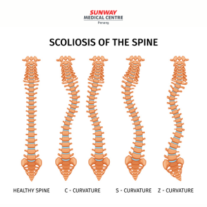 Scoliosis of spine