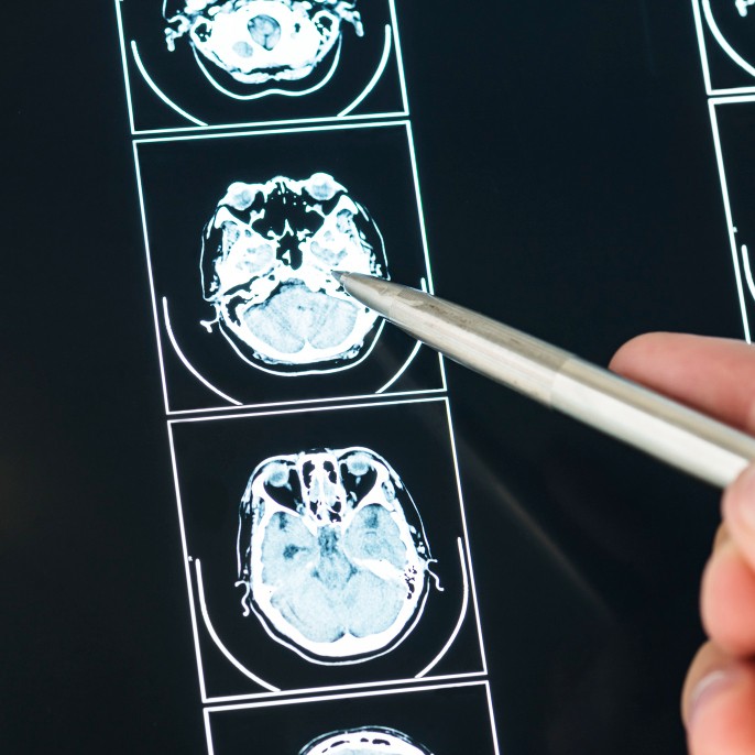 Closeup of brain mri scan result