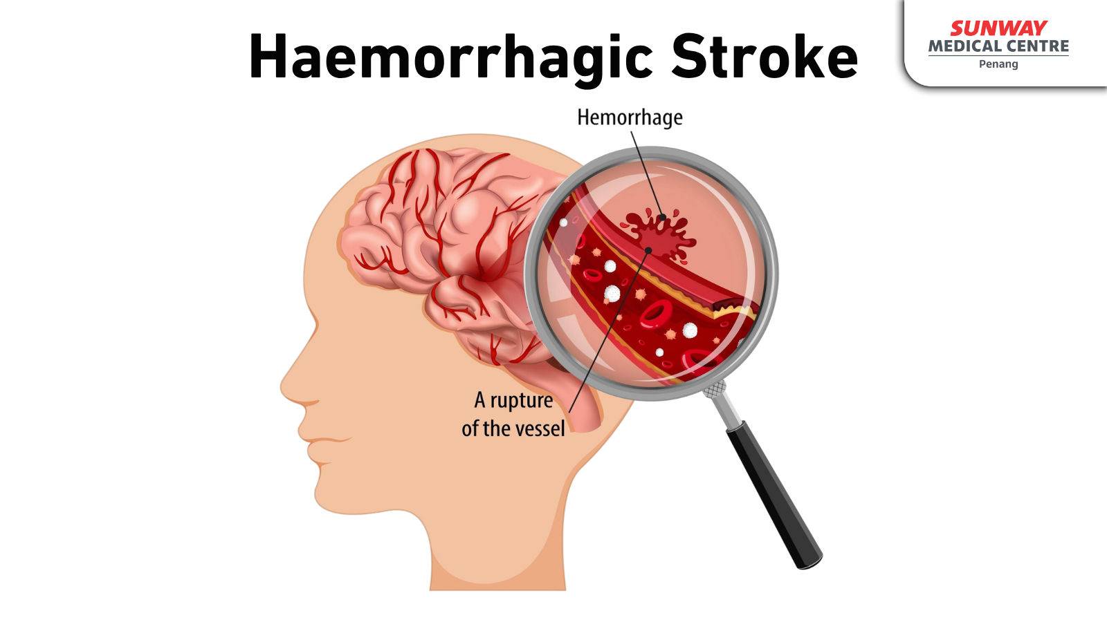 Haemorrhagic Stoke