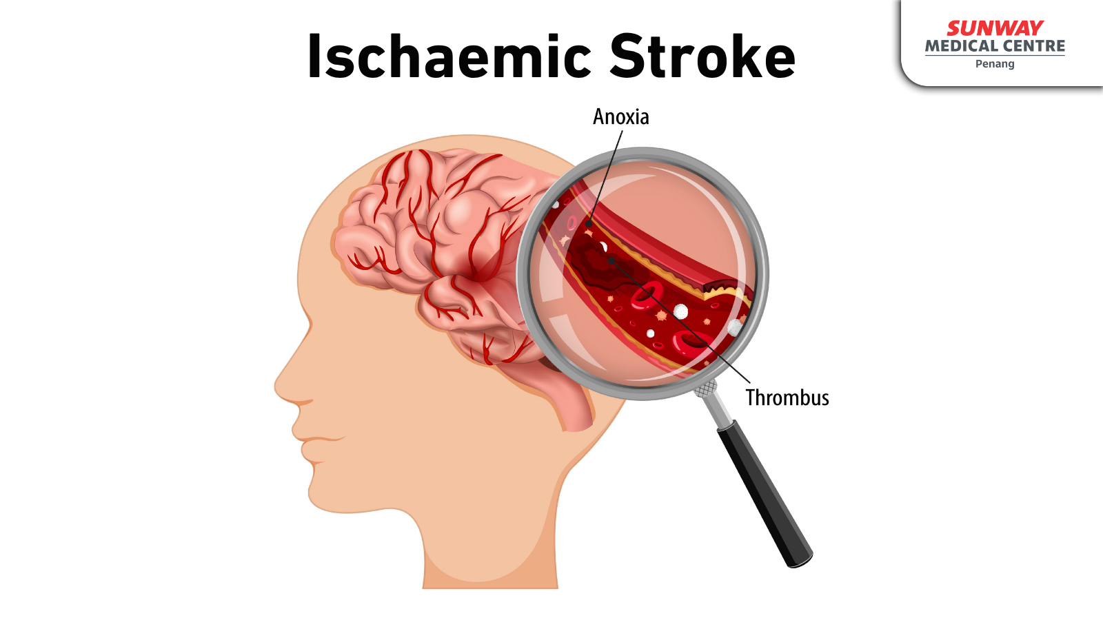 Ischaemic Stroke