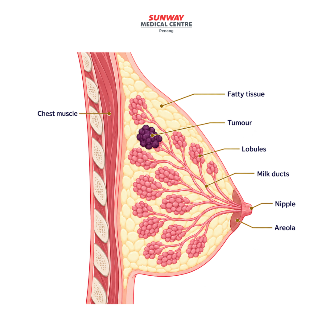 Breast anatomy cross-section showing a tumour in dark purple, with labelled lobules, milk ducts, fatty tissue, nipple, areola and chest muscle