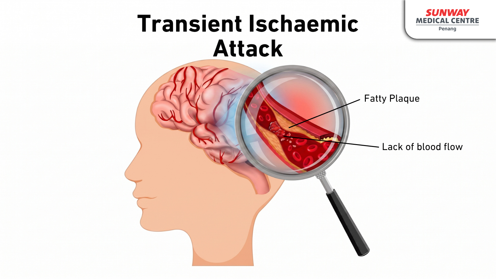 Mini Stroke - Transient Ischaemic Attack