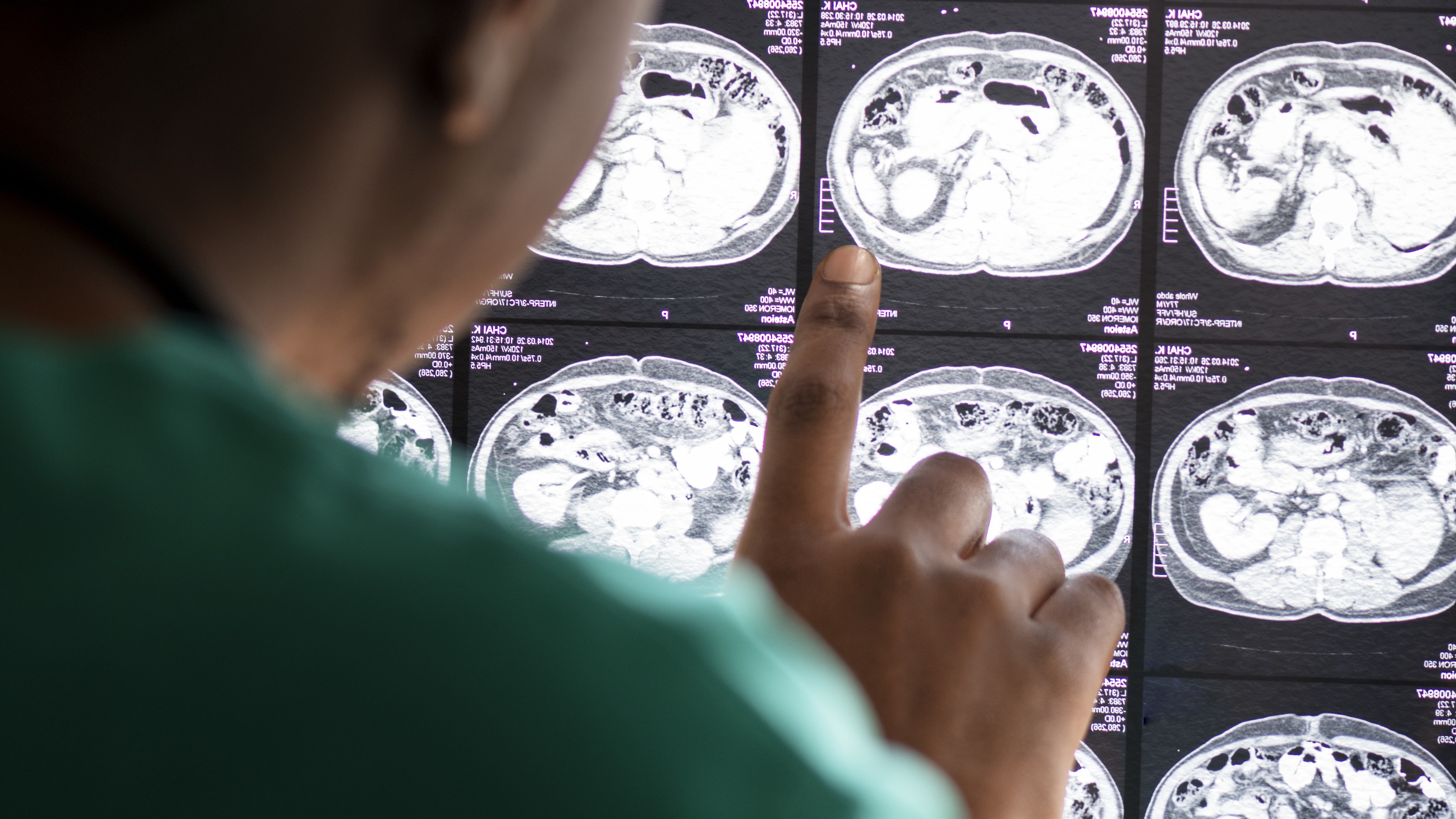 doctor reviewing brain scan MRI results